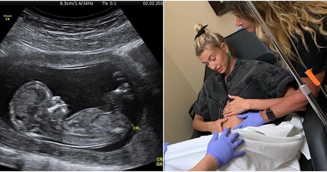 Justin Bieber du dinh co con anh 2