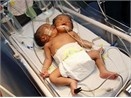 Them mot truong hop tre hai dau o Philippines hinh anh