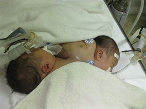 Mo tach hai be so sinh dinh nhau nguoc chieu hinh anh