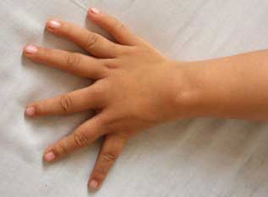 Ban tay 6 ngon gan giong nhau hinh anh