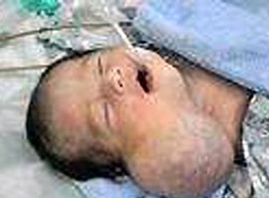 Cat khoi u hinh... dau nguoi cho be 1 thang tuoi hinh anh