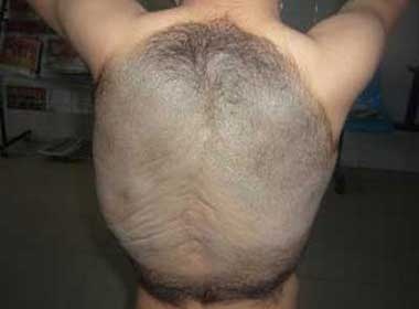 Phau thuat cat bo 'mai rua' cho cau be 8 tuoi hinh anh