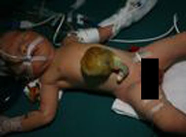 Be so sinh co gan nam ngoai o bung hinh anh