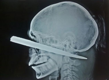 Song sot ki dieu sau khi bi thanh sat 25cm dam xuyen dau hinh anh