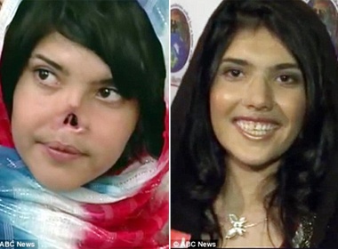 Co gai 19 tuoi bi chong cat mui da xinh dep tro lai hinh anh