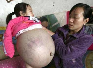 Co be 4 tuoi bung to nhu sap sinh con hinh anh