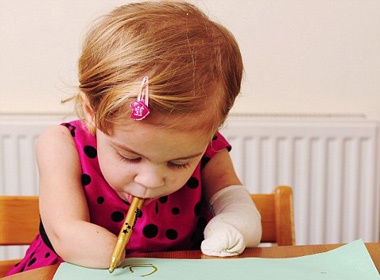 Nghi luc phi thuong cua be gai 3 tuoi cut chan tay hinh anh