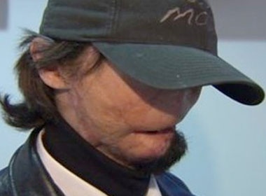 Ghep mat toan dien cho nan nhan dien giat hinh anh