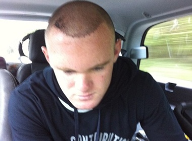 Rooney khoe toc sau khoa dieu tri benh hoi hinh anh