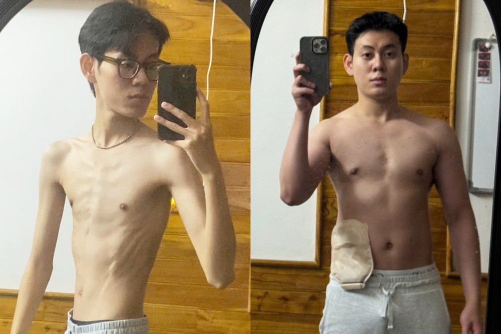 'Da boc xuong' vi om nang, chang trai lot xac khi tang 30 kg sau 1 nam hinh anh