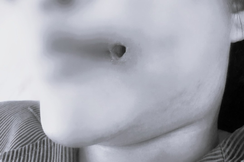 Mat bien dang vi hanh dong mao hiem voi o mu sau tiem filler hinh anh