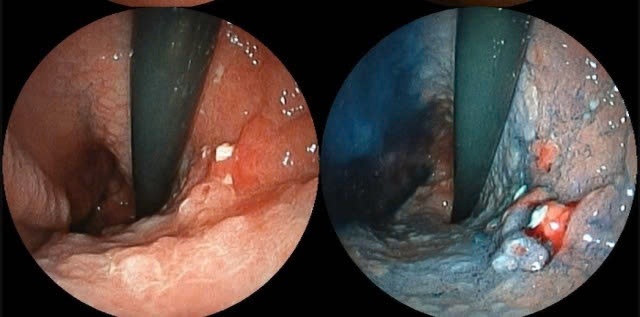 Vi sao ngay cang nhieu nguoi tre mac ung thu? hinh anh