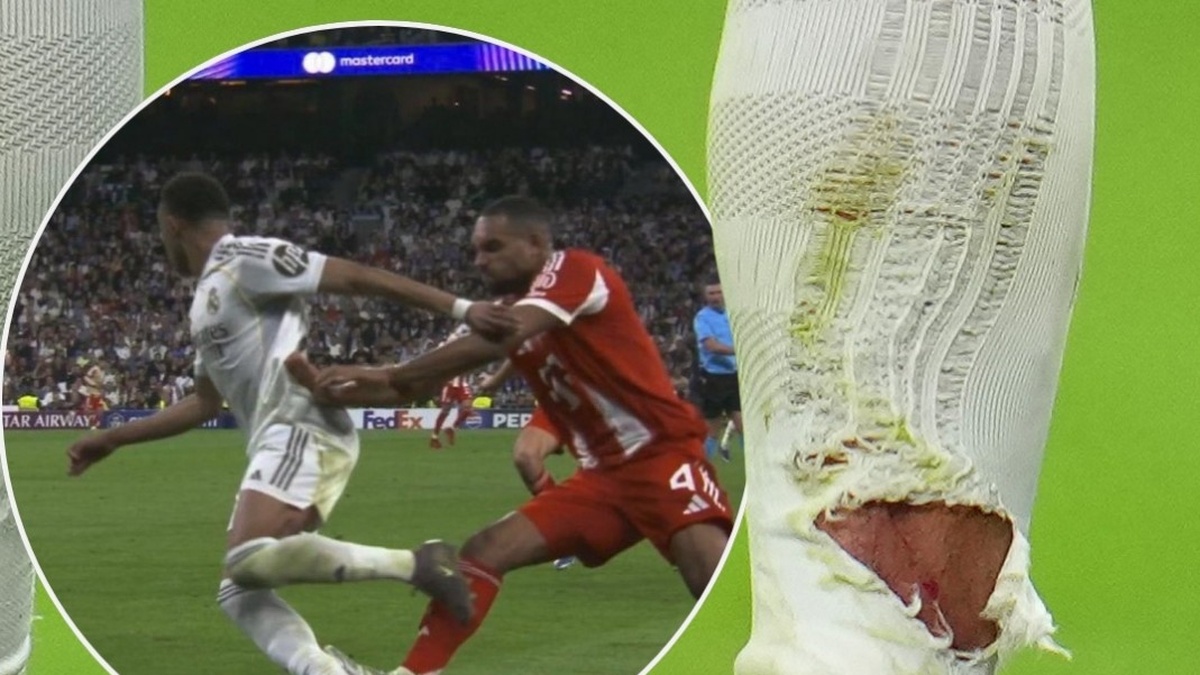 Vết thương gây lo lắng của Mbappe | Znews.vn