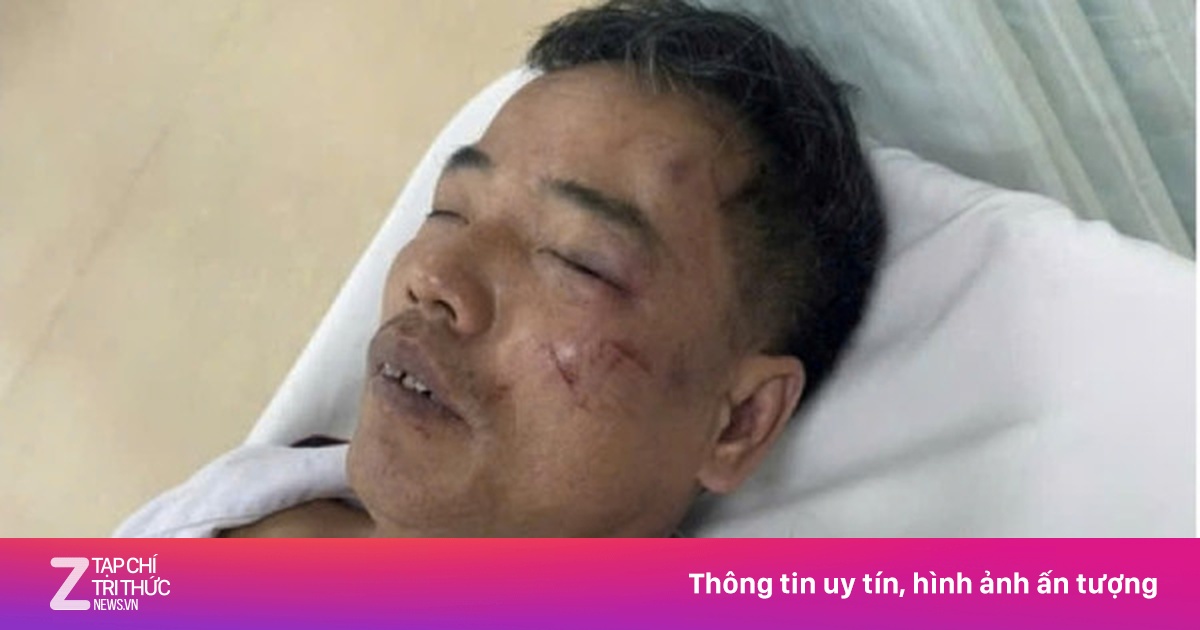 Truy tìm nhóm thanh niên nẹt pô, đánh bảo vệ gãy xương sườn