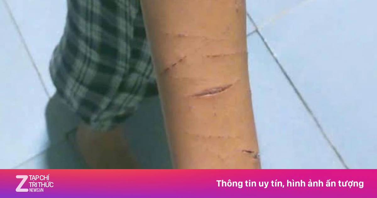 Chị họ lớp 5 rạch tay em bằng dao rọc giấy