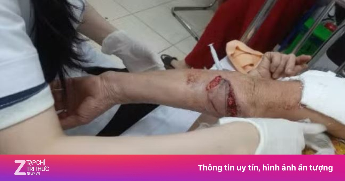 Chó lạ hung hãn tấn công ba phụ nữ đi tập thể dục tại Nghệ An