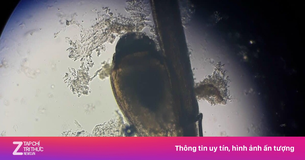 Rùng mình phát hiện ổ rận mu lúc nhúc trên lông mi