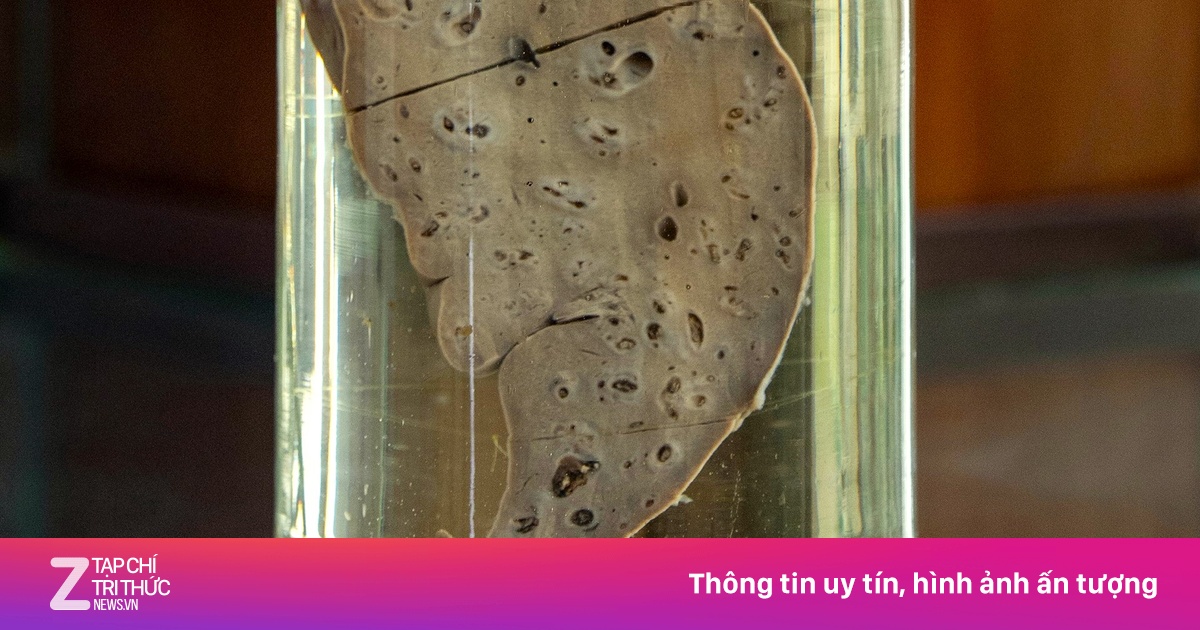 Món khoái khẩu khiến người đàn ông nhiễm cả 2 loại ký sinh trùng