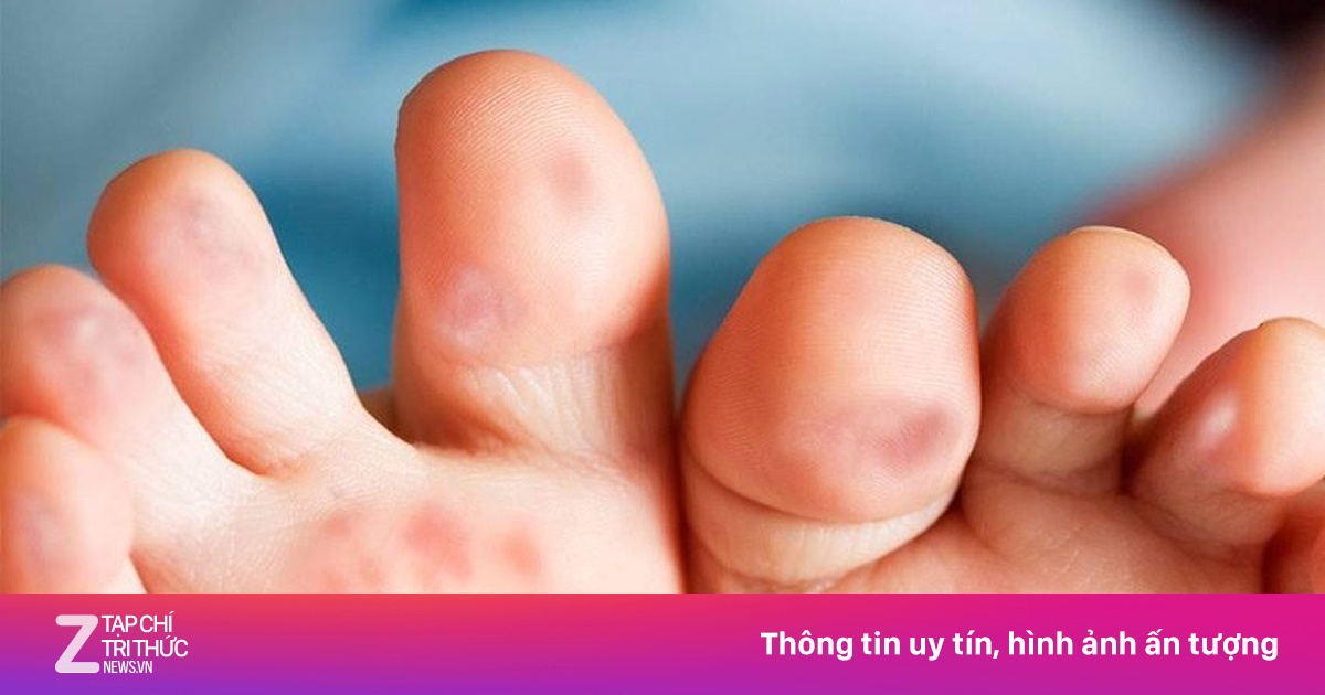 Trẻ chưa tiêm vaccine sởi, phụ huynh cần làm gì?