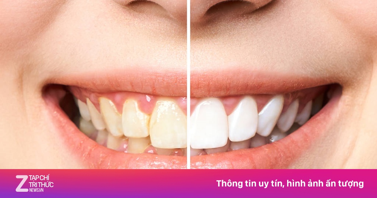 Răng ố vàng làm sao cho trắng?
