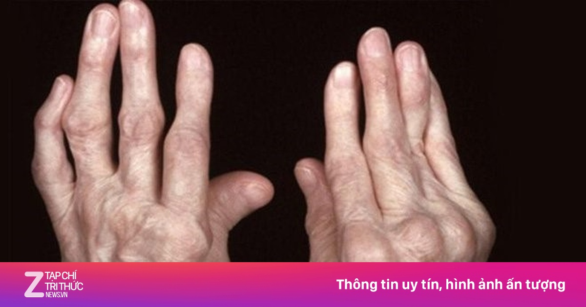 Ai dễ mắc viêm khớp dạng thấp?