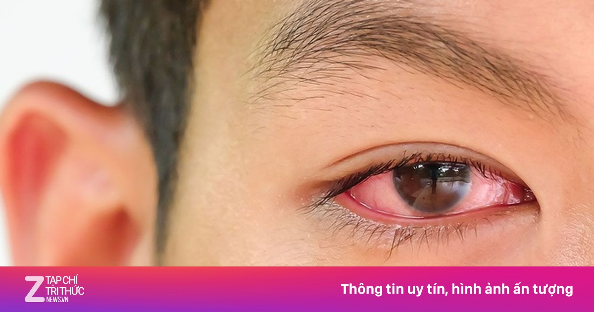 Dấu hiệu chứng tỏ bạn đang bị đau mắt đỏ