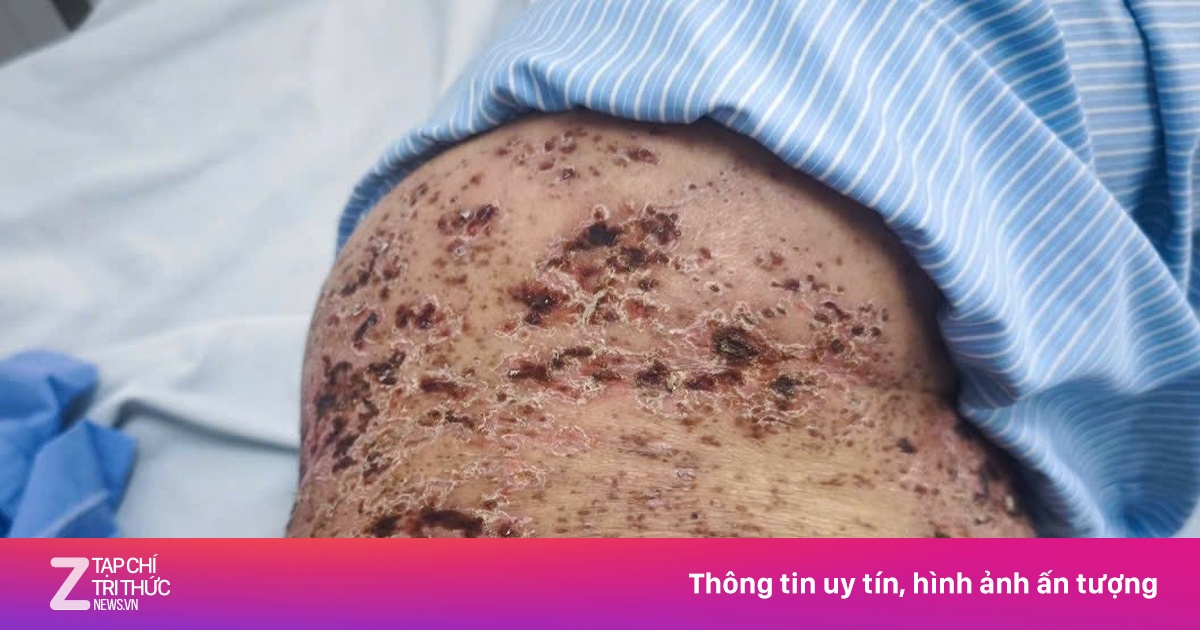 Zona thần kinh gây đau đớn ra sao?