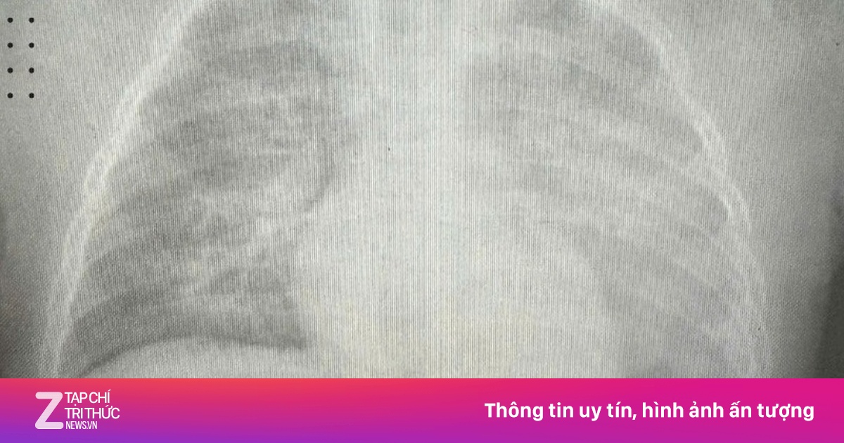 Từ ho, sốt đến 'trắng xóa' hai lá phổi trong vòng 6 giờ