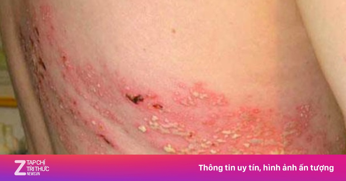 Mắc zona thần kinh có cần kiêng gì không?