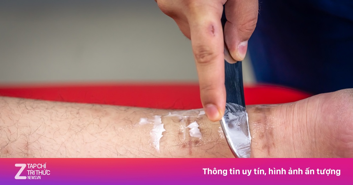 Vết phỏng tưởng vô hại suýt cướp mạng người đàn ông