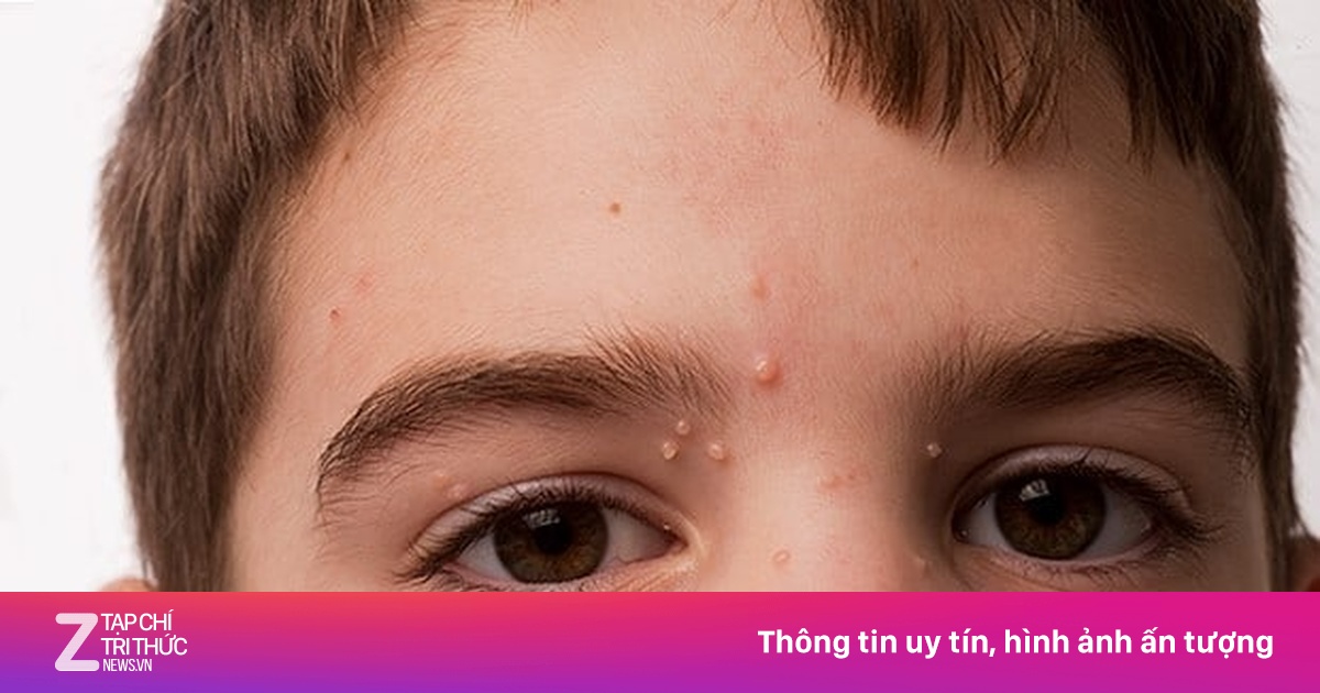 Bệnh u mềm lây dễ nhầm lẫn với bệnh ngoài da