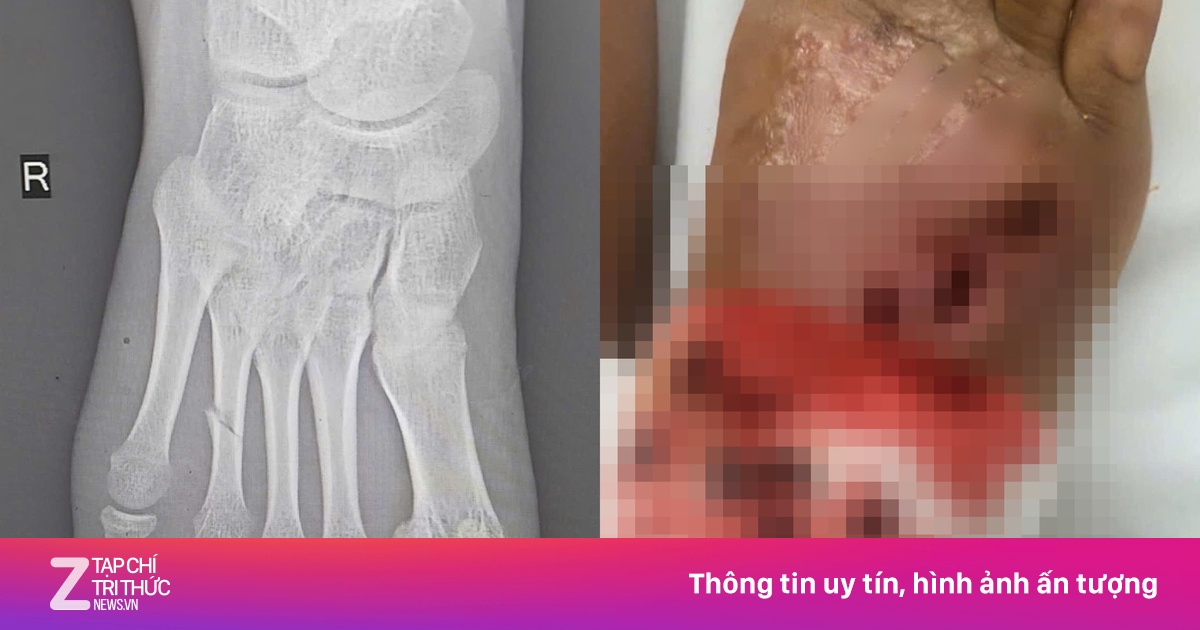 Bé gái suýt mất chân vì bó thuốc nam chữa gãy xương tại nhà