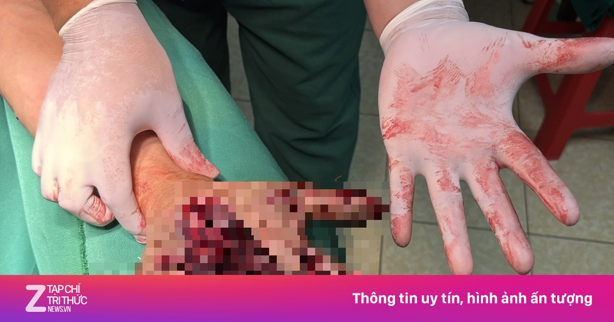 Dùng điện thoại khi đang sạc, người đàn ông bị chẻ đôi bàn tay