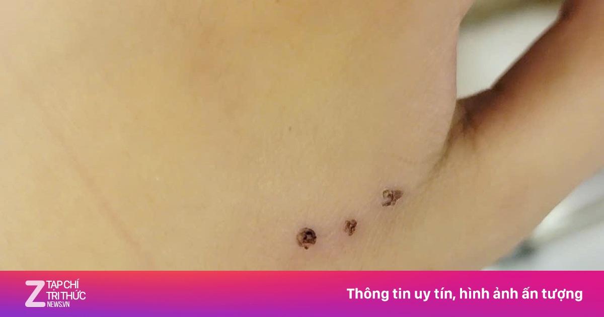 Bé 10 tuổi nhập viện vì bị chuột cắn