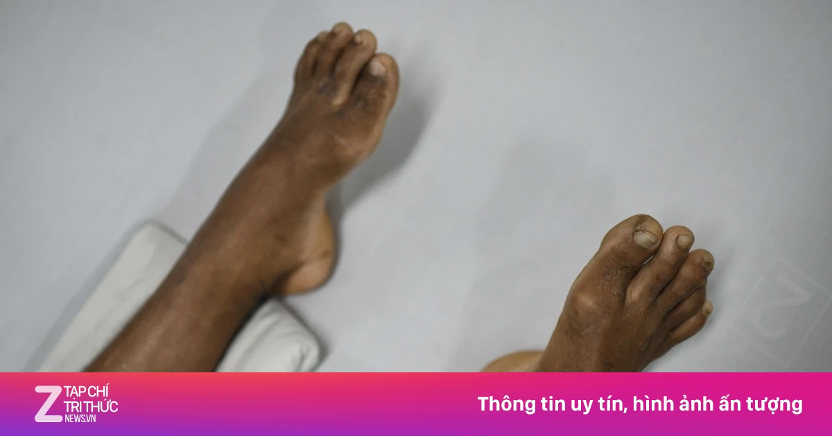 Căn bệnh từ vết trầy xước nhỏ có thể cướp đi mạng sống