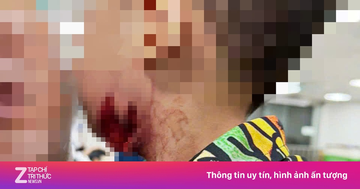 Bé 2 tuổi bị chó tấn công, rách cổ sát mạch cảnh