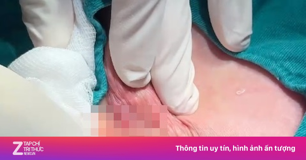 Bỏ gần trăm triệu nâng mông, 2 phụ nữ nhận 'kết đắng'