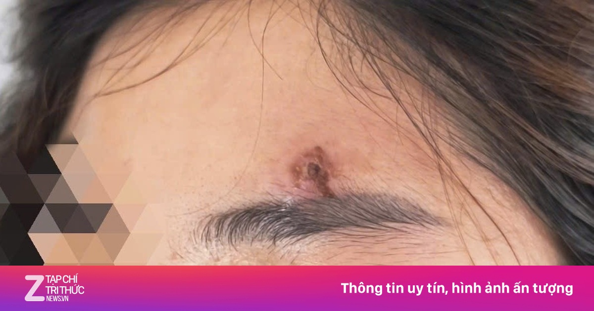 Tự nặn mụn, người phụ nữ ở Hà Nội bất ngờ rơi vào nguy kịch