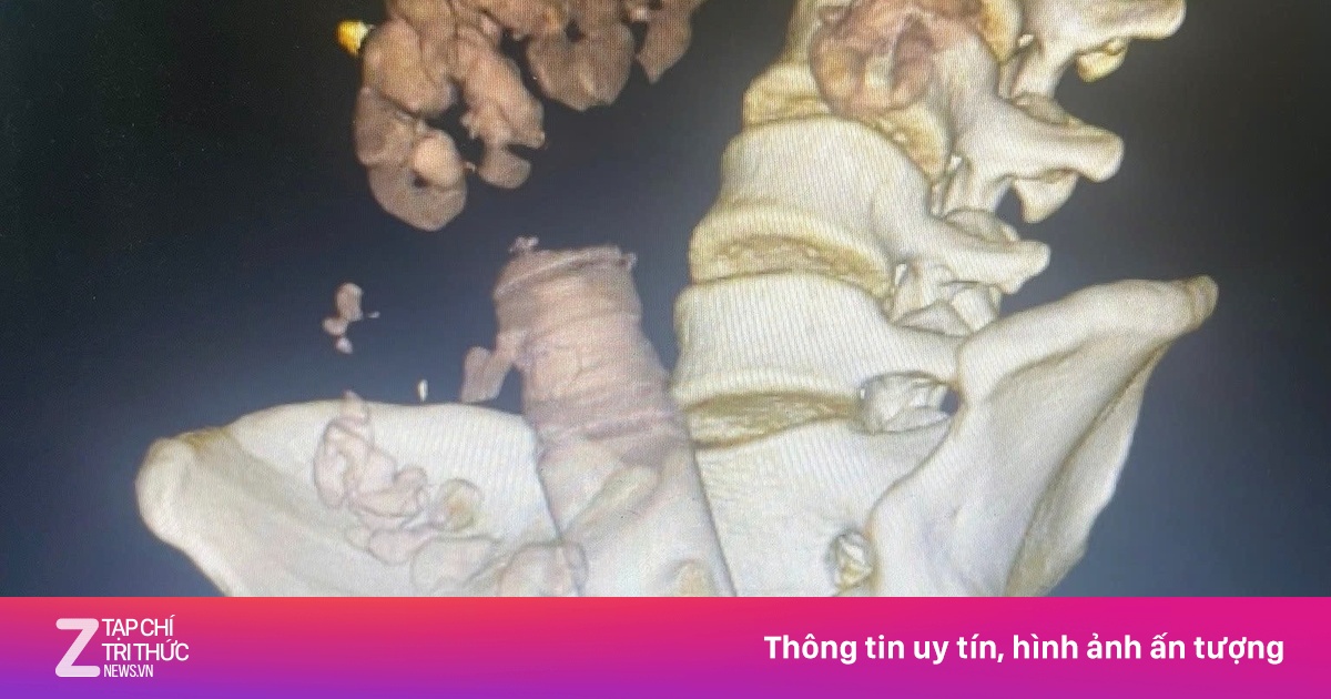 Tự chế đồ chơi tình dục, nam thanh niên nhập viện vì dị vật 'mắc kẹt'