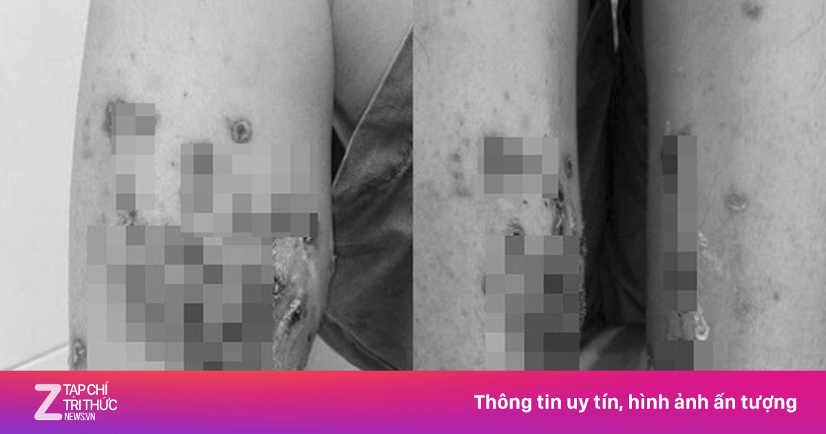 Lội nước bẩn, người đàn ông phải nhập viện vì viêm da lan rộng
