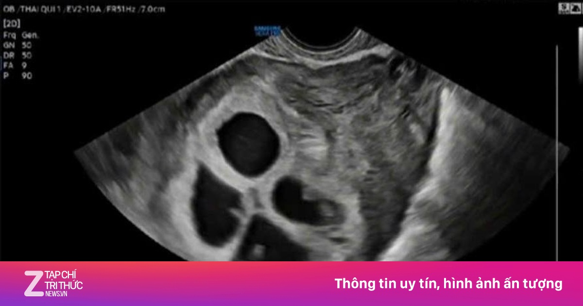 Thai phụ mang tự nhiên 4 thai, tỷ lệ chỉ 1/800.000