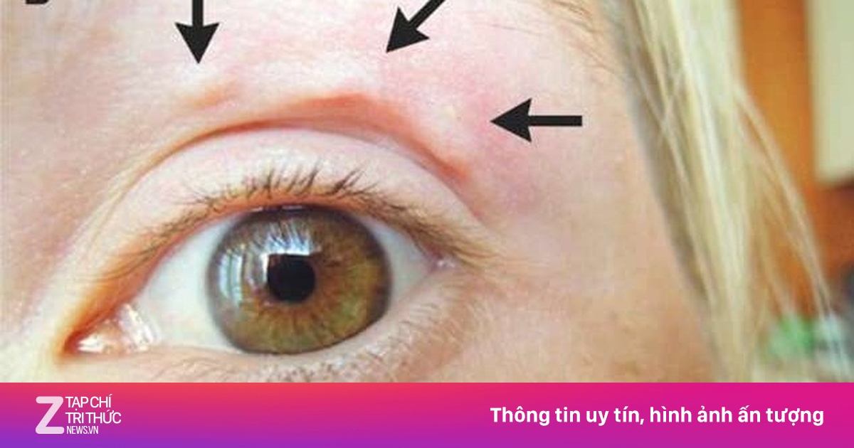 Sợ giun ẩn trong mắt, đâu là cách phát hiện?