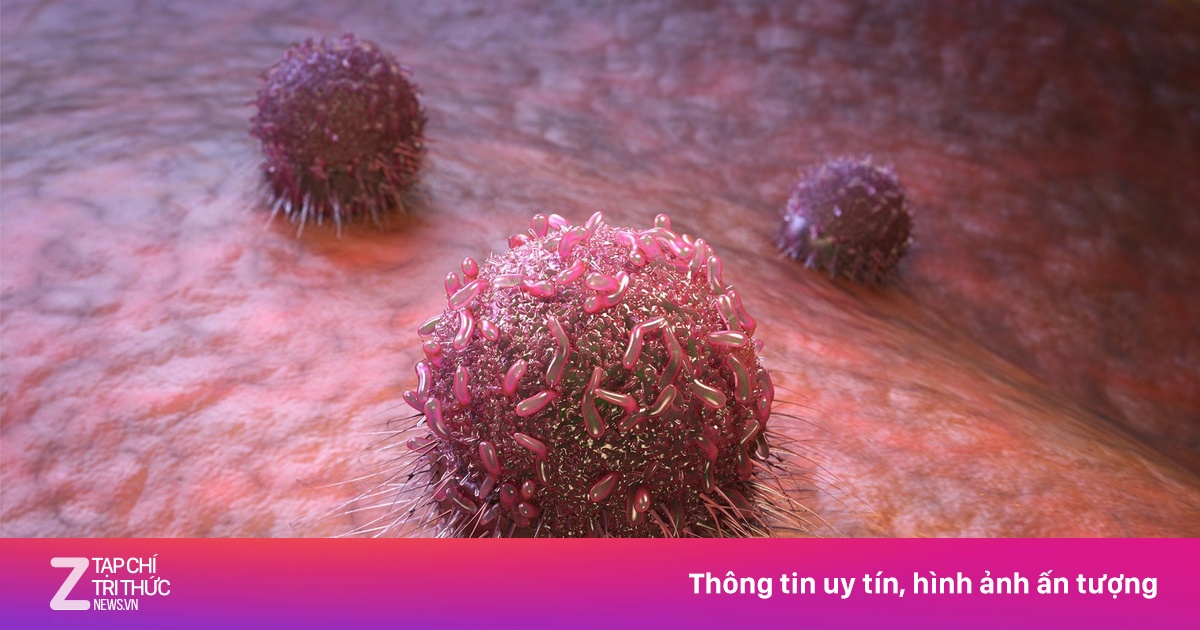 Người đàn ông mắc ung thư miệng, thực quản và đại tràng | Znews.vn