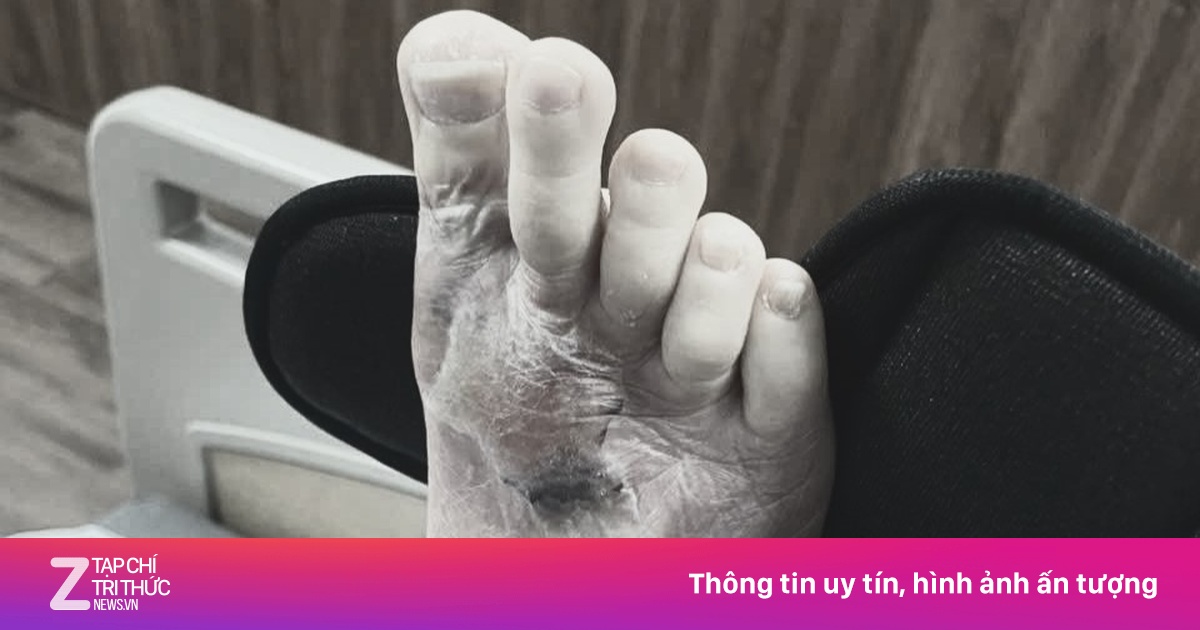 Bàn chân suýt mất chỉ vì vết xước tưởng vô hại