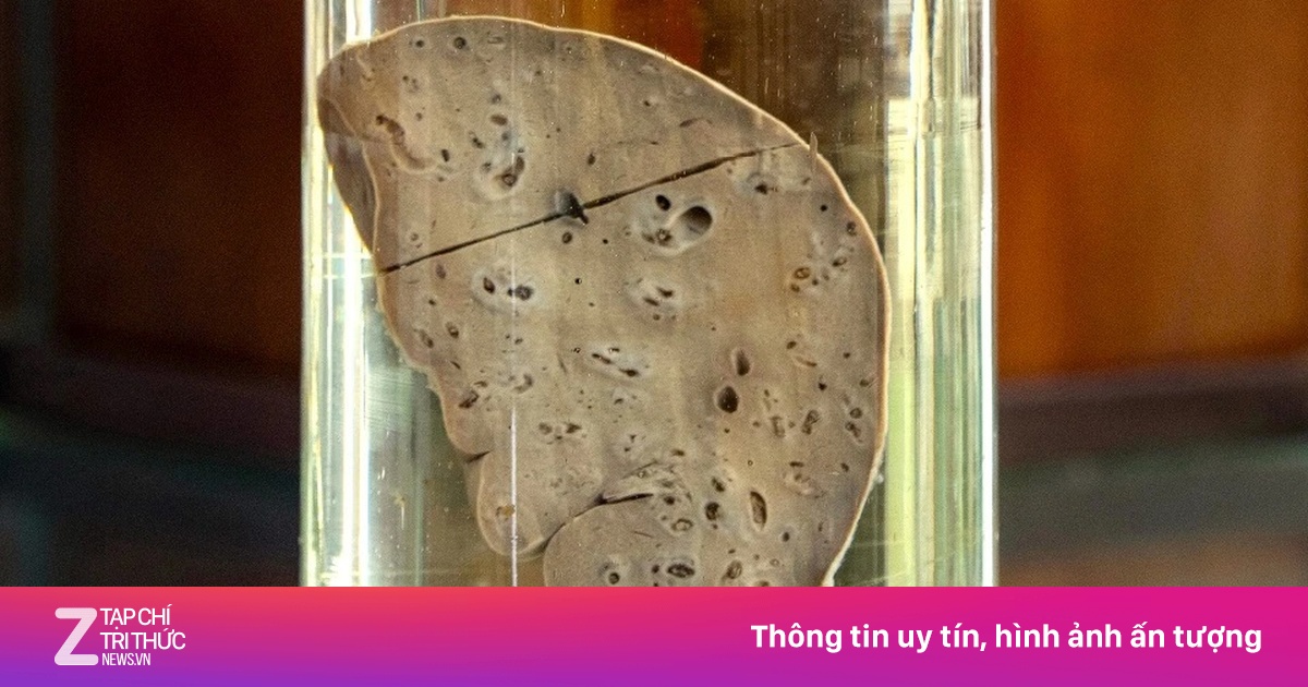 Một kiểu ăn uống có thể hủy hoại gan