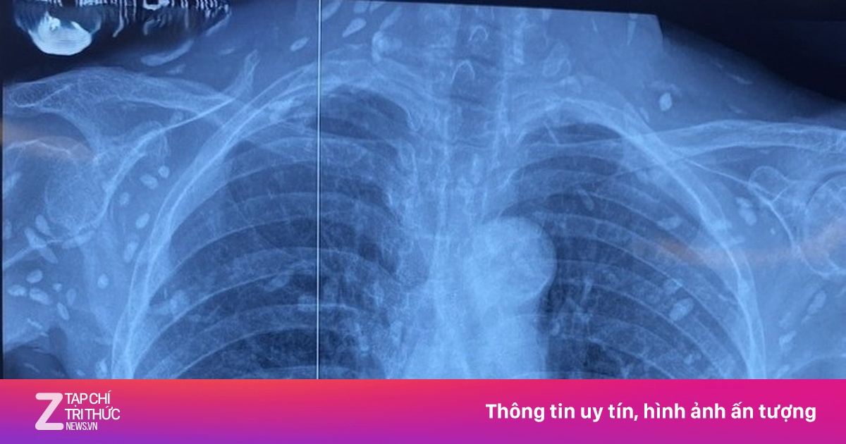 Dấu hiệu chứng tỏ bạn đã nhiễm sán dây lợn