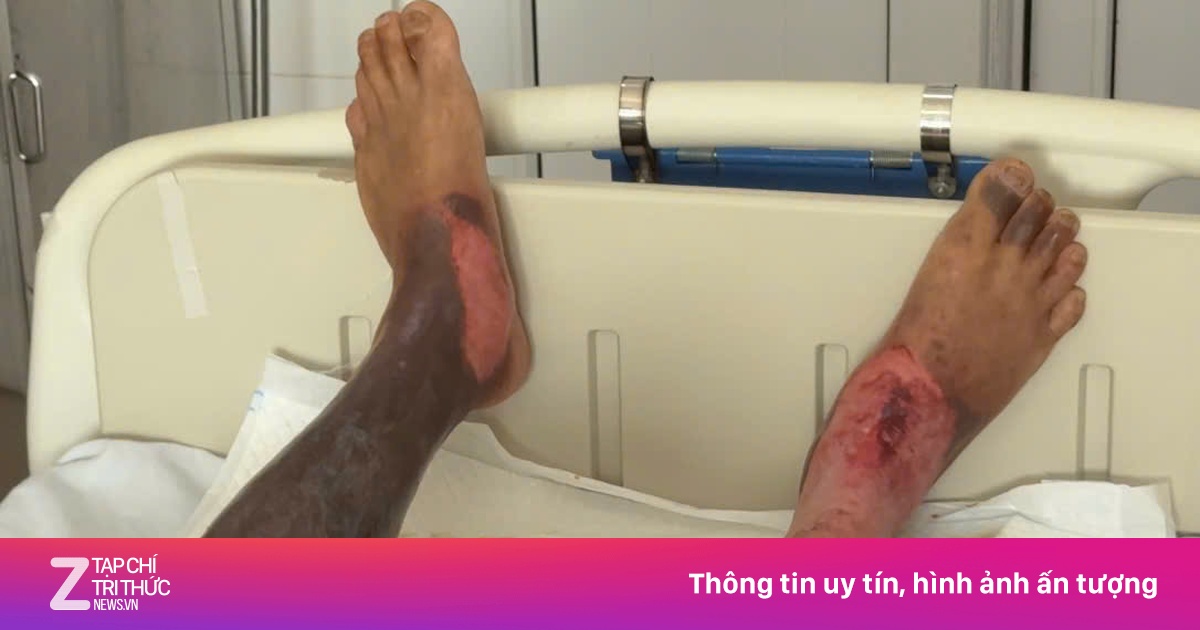 Người đàn ông bị bỏng thương tâm dù không chạm vào dây điện