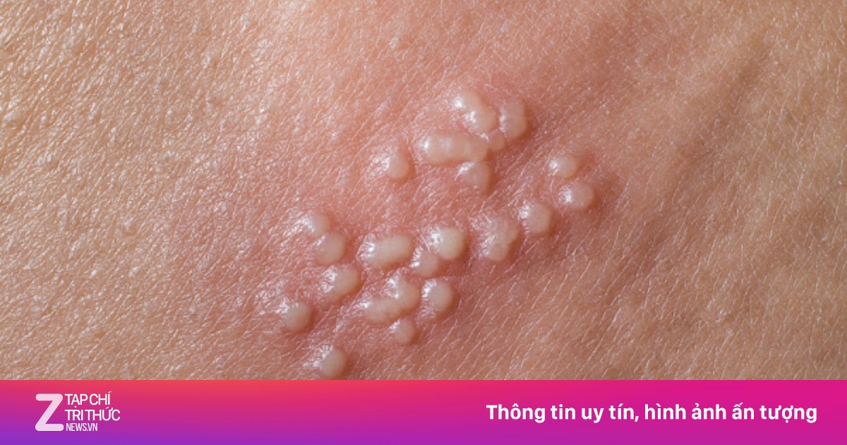 Nguyên nhân gây bệnh mụn rộp sinh dục