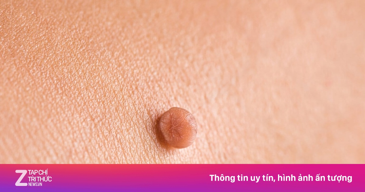 Dấu hiệu mắc mụn cóc sinh dục giai đoạn đầu