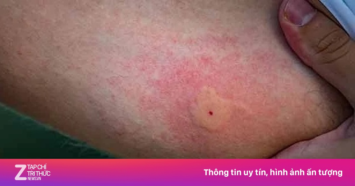 Cúm mùa gia tăng, dịch sốt xuất huyết vào cao điểm